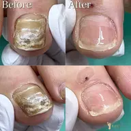 【変形爪の補正】朗報★【得2回目以降も施術料が500円得】 厚みや変形の気になるお爪が正常なお爪となります!