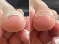 【フット】巻き爪ケア ※レジスタンスプレート親指1本¥2300