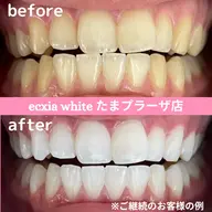 人気No.1!!平均5トーンUP⭐︎たっぷり60分プレミアム歯科ホワイトニング初回体験 ¥14800→¥11000