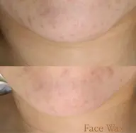 つるん肌💎透明感UPフェイスWAX+光脱毛
