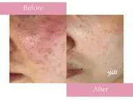 \1周年記念/ ✨【人気No.1💎90分コース】毛穴、肌荒れ、ニキビ集中ケア★美容導入も付けさせていただきます✨️