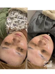 【肌質底上げ🌿】ハーブピーリング