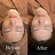 🤍【水玉リフティングコース】🤍韓国でも今話題🇰🇷💗ㅎㅎこの夏お肌悩み🤔💭ゼロの肌へ🧏🏻♀️💖