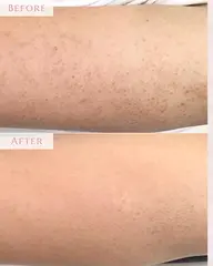 【ミニモ限定価格❤️‍🔥】二の腕集中ケア❗️ハーブピーリングで魅せ肌仕上げ🌿✨初回¥22,000→¥13,000