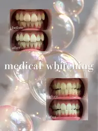 【歯科提携】本格メディカルホワイトニング🦷🫧✨通常¥12,100→限定¥4,180❣️