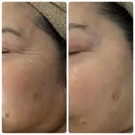 光フェイシャル