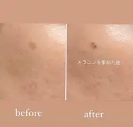 【スポットケア●○】Othelloスポットケア●○10分当て放題 ¥3,980