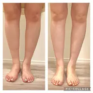 キャビテーション20分➕リンパドレナージュ10分