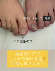 🦶巻き爪補正　　1本¥2,500