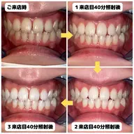 【 メンズ限定 】🔹 メンズ美歯集中プラン 〈 40分×3来店   合計120分照射  〉🔹