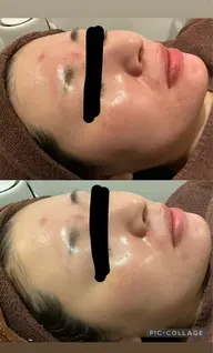 新春cp⛩️毛穴洗浄＆痛くない水光注射(オリジナルパック付)