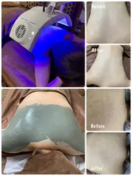 【ボディケア】3色ブレンドLED照射&ボディケアパック✨背中・二の腕・デコルテ・お尻のニキビやザラザラ感、くすみのケアに