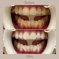 【再来】超音波セルフホワイトニング20分照射 ×1回🦷✨　¥7,000→¥6,300