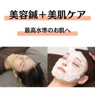 【🧖‍♀️初回限定🪡】ぷる艶肌🫧美容鍼＋美肌クレンジング＋炭酸パック（90分）　💄メイクオフ不要