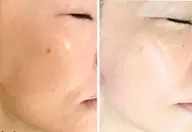 【モヤモヤしたシミにはこれ‼️】15分当て放題/特別3回モニター通常49,500円→32,500円