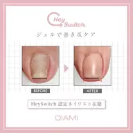 巻き爪ケア "機能性ジェルや、アクリルで巻き爪を広げます"両親指