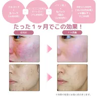 1ヶ月で肌質改善！エステモニター募集