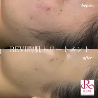 【3月末まで期間限定】お試しハーブピーリング