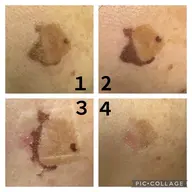 新規様限定❕是非お試し下さい✨️💗シミにお悩みの方おすすめです💗光フェイシャル➕シミスポットケア(15分)