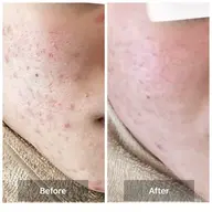 👑人気No.1 ハーブピーリング👑【剥離あり】【毛穴洗浄】【GF美容液】ニキビ/ニキビ跡/黒ずみ/水光肌/毛穴ケア