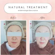 minimo sale2/29まで【最新マシンですっきり小顔】❤ヒアルロン酸増量うるツヤ美肌✨エンダモロジー フェイス✨