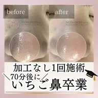 【70分でいちご鼻卒業🎓】鼻の黒ずみ毛穴がツルツルに✨70分11,000円→初回7,700円💆‍♀️