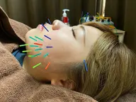 【美容鍼🪡✨️】