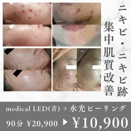 【ニキビ集中改善】韓国LED(青)＋水光ピーリング　¥20,900→¥10,900