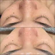 【毛穴撃退】黒ずみ・角栓ごっそりフェイシャル