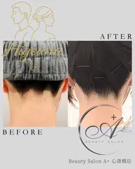 【ひげうな脱毛】口周り+うなじ！即冷却の痛み軽減脱毛🌈ムダ毛脱毛でストレスフリーに🌟（都度払いOK脱毛）