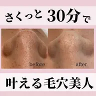 現金払い限定💰気になるパーツだけの小鼻すっきりエステ