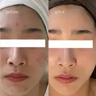 平日限定【圧倒的人気No. 1】水光ピーリング ¥19,800→¥8,800