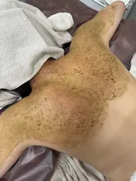 【背中ニキビ・くすみ・ブライダル】＊夏に向けて＊上背部から二の腕剥離ハーブピーリング