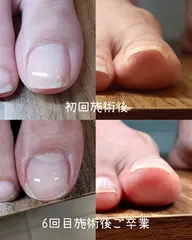 ジェルでの巻き爪矯正【1趾】