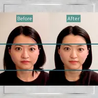 再来1ヶ月以内の方！癒着剥がし美容鍼・小顔矯正・最後顔から肩のマッサージ