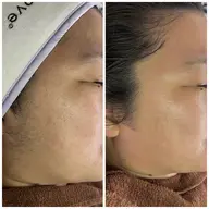 【肌質改善フェイシャルワックス】ニキビや炎症が気になる、できやすい方！！お得すぎるホームパック3日分set🎁