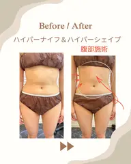 【ぽっこりお腹をすっきりさせたい方に】ハイパーナイフ20分＋ハイパーシェイプ10分