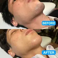 メンズ髭脱毛（顔全体）通常都度払い4950円→2200円