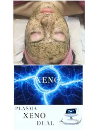 🉐【3名様限定】《プラズマゼノデュアル》+《ハーブピーリング》スペシャルコース ニキビ/トラブル肌の方必見!