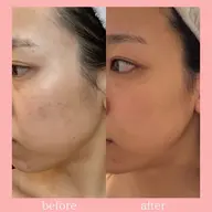 ミニモ限定クーポン✺⋆*絶対に綺麗になりたい人に🔥本気の肌質改善🌿✨️剥離•ダウンタイム有！シミ・毛穴開き・ニキビ◎