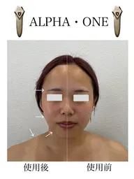 【美顔器〈アルファワン〉】EMS×イオン導入!小顔・ハリ・透明感を叶える次世代フェイシャルケア