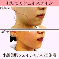 【小顔×美肌フェイシャル】驚きの小顔施術でもたついたフェイスラインもスッキリ!♪デコルテ込み《初回限定💫特別価格》