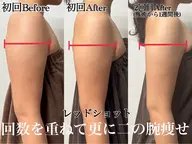 【最新美容🌟レッドショット💉❤️】すぐ実感できる韓国発🇰🇷脂肪撃退💕3cc導入で二の腕やお腹痩せ👊💥