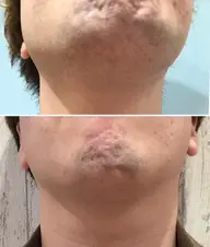 ミニモ限定【男の身だしなみ✨当店人気No.1!メンズヒゲ脱毛初回 ¥3300→¥2200!】痛み少なめ☆