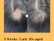 世界初🌏【育毛促進ヘアスピキュール】ヘッドスパ15分+頭皮美容液導入 副作用なし!高コスパ!