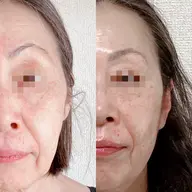 【たるみ防止】リフトケアフェイシャルコース