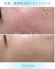 【乾燥・敏感肌ケアトリートメント】★(乳酸菌)ミルクピーリング