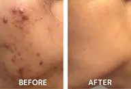 人気No.2 ”むきたてたまご肌体験”肌荒れ・ニキビ・ゆらぎ肌をリセット【ハーブピーリング】¥7500→¥6000