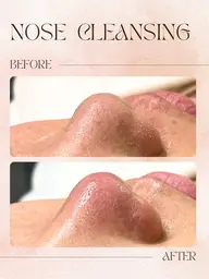 【🩵推し活前に🩵】顔剃り+小鼻洗浄+うなじ+保湿パック