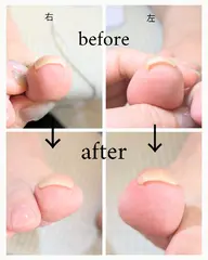 【フット】巻き爪が広がる!特殊ジェル(クリア)